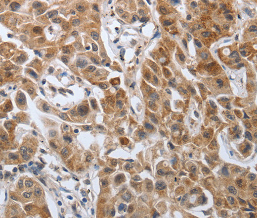 Immunohistochemistry of paraffin-embedded Human lung cancer tissue using PDGFA Polyclonal Antibody at dilution 1:40