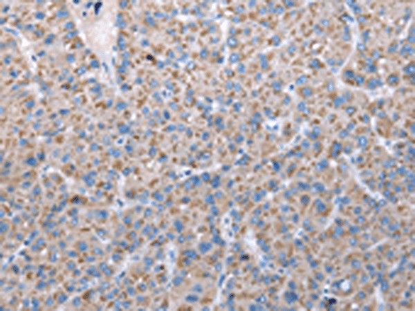 Immunohistochemistry of paraffin-embedded Human liver cancer tissue  using FKBPL Polyclonal Antibody at dilution of 1:50(?200)