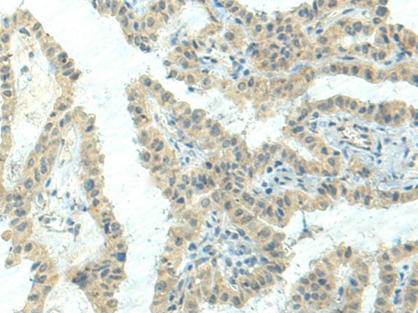 Immunohistochemistry of paraffin-embedded Human thyroid cancer tissue  using NPVF Polyclonal Antibody at dilution of 1:80(?200)