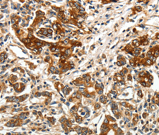 Immunohistochemistry of paraffin-embedded Human gastric cancer tissue using BIRC6 Polyclonal Antibody at dilution 1:40