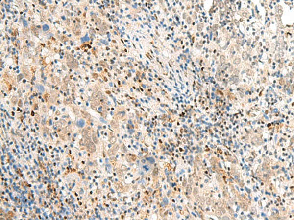 Immunohistochemistry of paraffin-embedded Human cervical cancer tissue  using POM121 Polyclonal Antibody at dilution of 1:40(?200)