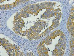 Immunohistochemistry of paraffin-embedded Human colon cancer tissue using CK-19 Monoclonal Antibody at dilution of 1:200.