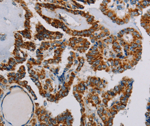 Immunohistochemistry of paraffin-embedded Human thyroid cancer using NDUFS3 Polyclonal Antibody at dilution of 1:30