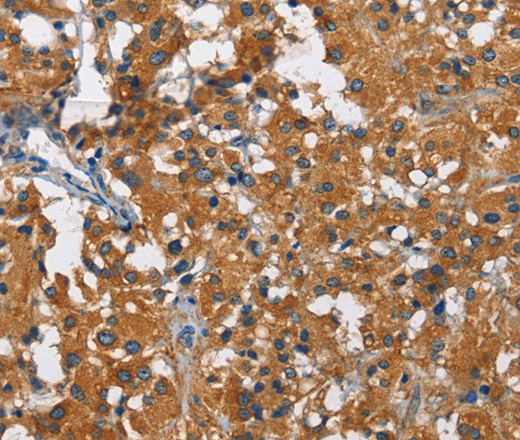 Immunohistochemistry of paraffin-embedded Human thyroid cancer using KLF7 Polyclonal Antibody at dilution of 1:60