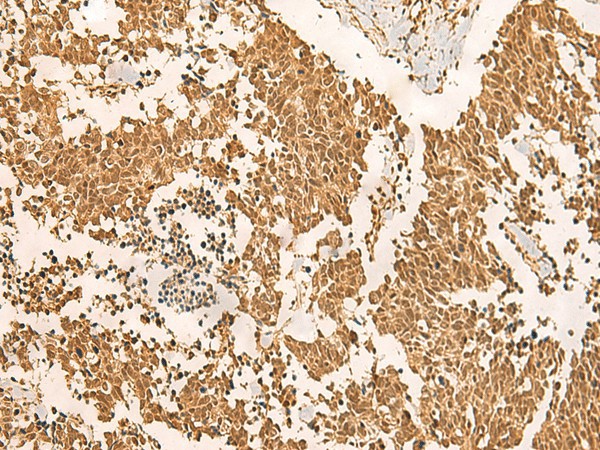 Immunohistochemistry of paraffin-embedded Human lung cancer tissue  using EFTUD2 Polyclonal Antibody at dilution of 1:45(?200)