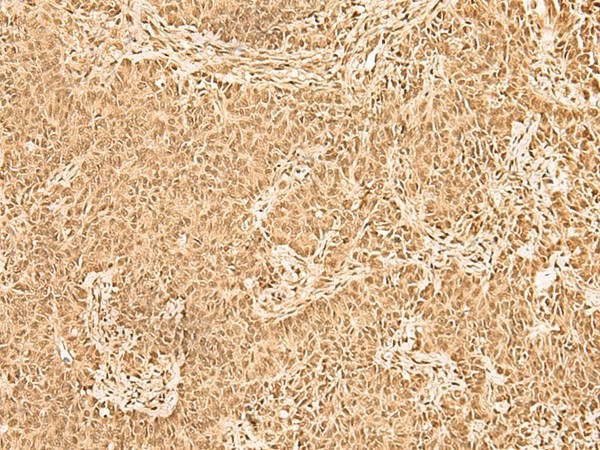 Immunohistochemistry of paraffin-embedded Human ovarian cancer tissue  using ZNF471 Polyclonal Antibody at dilution of 1:50(?200)