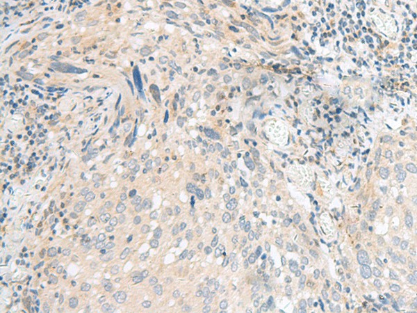 Immunohistochemistry of paraffin-embedded Human cervical cancer tissue  using CALCOCO1 Polyclonal Antibody at dilution of 1:40(?200)