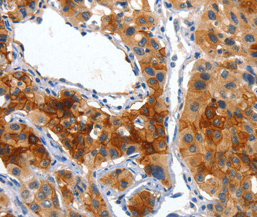 Immunohistochemistry of paraffin-embedded Human lung cancer using Placental Alkaline Phosphatase Polyclonal Antibody at dilution of 1:50