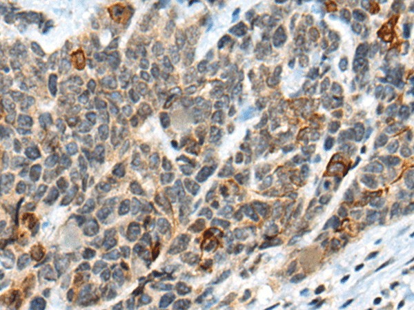 Immunohistochemistry of paraffin-embedded Human thyroid cancer tissue  using ATRX Polyclonal Antibody at dilution of 1:50(?200)