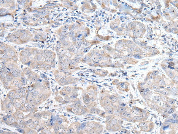 Immunohistochemistry of paraffin-embedded Human breast cancer tissue  using RASA1 Polyclonal Antibody at dilution of 1:45(?200)