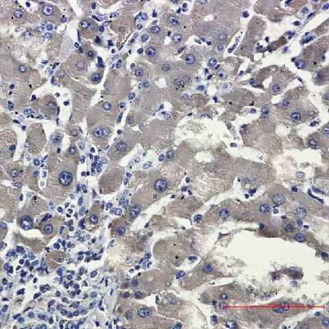 Immunohistochemistry of CYP2D6 in paraffin-embedded liver cancer tissue using CYP2D6 Rabbit mAb at dilution 1:50