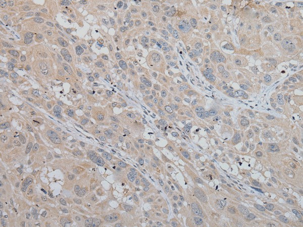 Immunohistochemistry of paraffin-embedded Human esophagus cancer tissue  using MLANA Polyclonal Antibody at dilution of 1:50(?200)