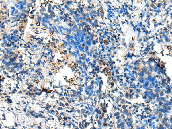 Immunohistochemistry of paraffin-embedded Human lung cancer tissue  using NUDT10 Polyclonal Antibody at dilution of 1:70(?200)