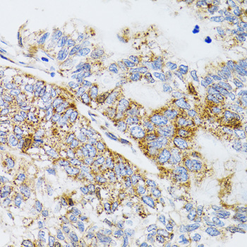 Immunohistochemistry of paraffin-embedded Human gastric cancer using PDYN Polyclonal Antibody at dilution of 1:100 (40x lens).