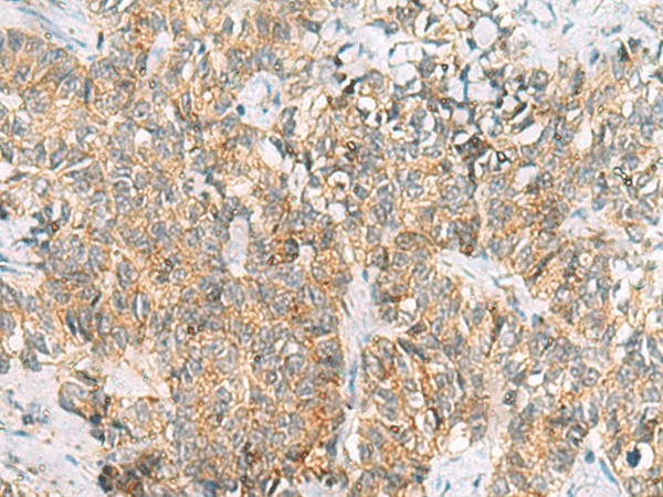 Immunohistochemistry of paraffin-embedded Human ovarian cancer tissue  using TUFT1 Polyclonal Antibody at dilution of 1:120(?200)