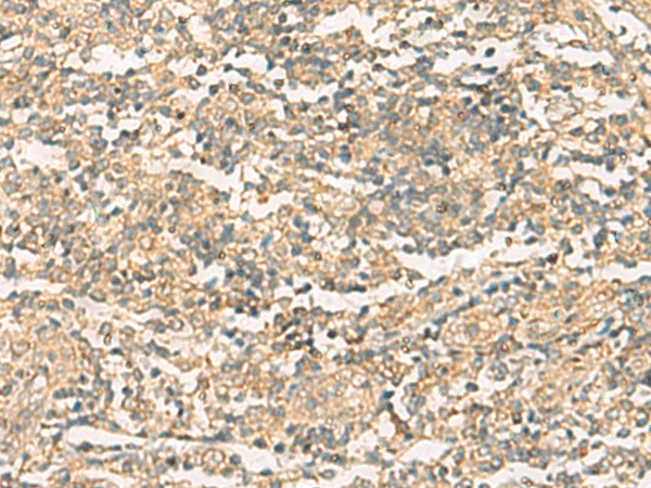 Immunohistochemistry of paraffin-embedded Human tonsil tissue  using NQO2 Polyclonal Antibody at dilution of 1:50(?200)