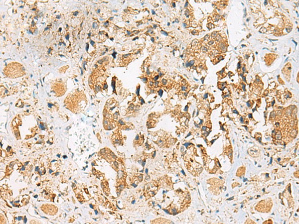 Immunohistochemistry of paraffin-embedded Human prost ate cancer tissue  using HEBP1 Polyclonal Antibody at dilution of 1:40(?200)