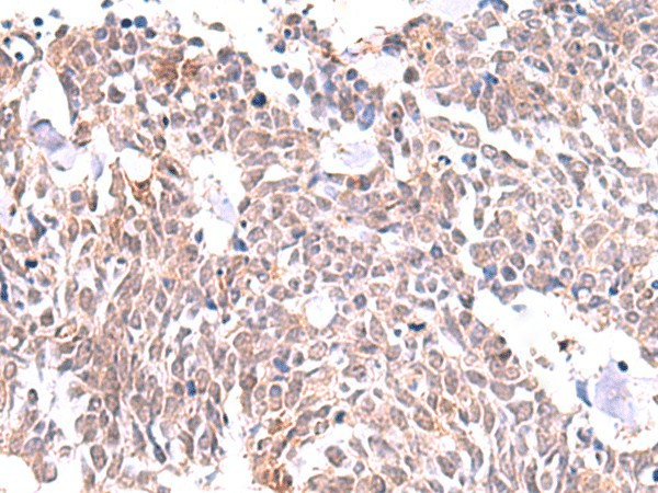 Immunohistochemistry of paraffin-embedded Human lung cancer tissue  using INPP5K Polyclonal Antibody at dilution of 1:85(?200)