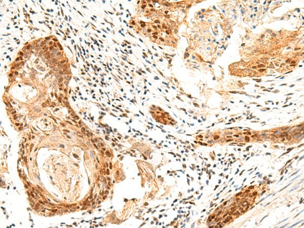 Immunohistochemistry of paraffin-embedded Human esophagus cancer tissue  using SETMAR Polyclonal Antibody at dilution of 1:60(?200)