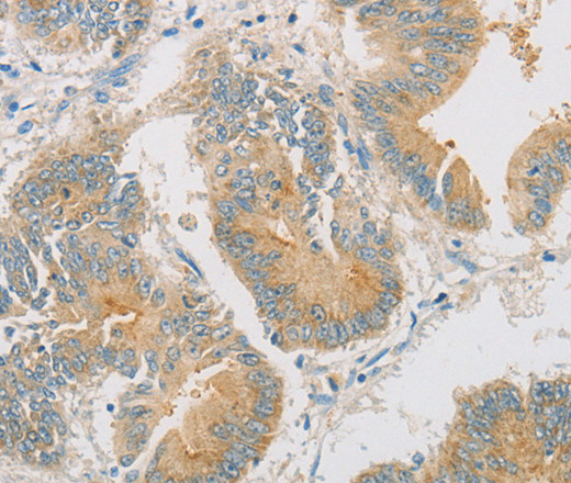 Immunohistochemistry of paraffin-embedded Human colon cancer tissue using ZWINT Polyclonal Antibody at dilution 1:50