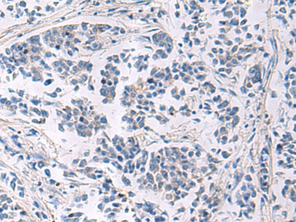 Immunohistochemistry of paraffin-embedded Human breast cancer tissue  using LAMP3 Polyclonal Antibody at dilution of 1:30(?200)