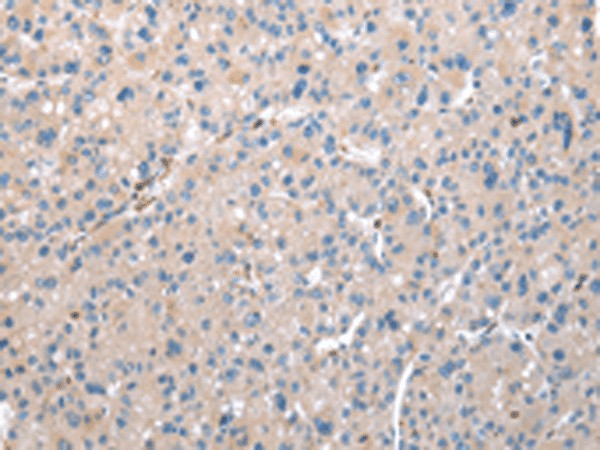 Immunohistochemistry of paraffin-embedded Human liver cancer tissue  using DCAF7 Polyclonal Antibody at dilution of 1:30(?200)