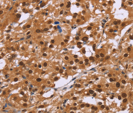 Immunohistochemistry of paraffin-embedded Human thyroid cancer tissue using CTNNBL1 Polyclonal Antibody at dilution 1:50