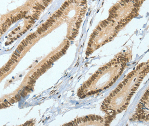 Immunohistochemistry of paraffin-embedded Human colon cancer tissue using ASH2L Polyclonal Antibody at dilution 1:50