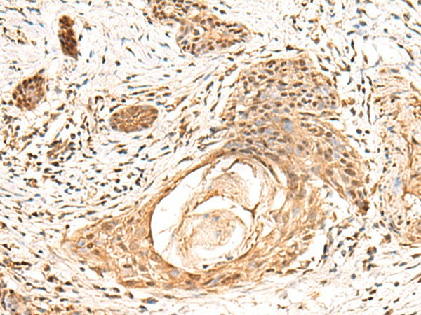 Immunohistochemistry of paraffin-embedded Human esophagus cancer tissue  using KCTD13 Polyclonal Antibody at dilution of 1:55(?200)