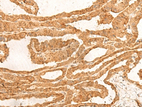 Immunohistochemistry of paraffin-embedded Human thyroid cancer tissue  using ZBTB8A Polyclonal Antibody at dilution of 1:100(?200)