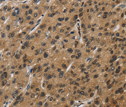 Immunohistochemistry of paraffin-embedded Human liver cancer using SYN1 Polyclonal Antibody at dilution of 1:50