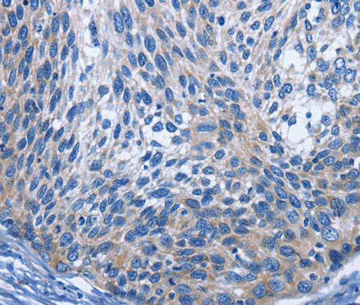 Immunohistochemistry of paraffin-embedded Human cervical cancer using IL2RB Polyclonal Antibody at dilution of 1:30