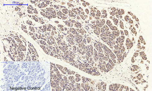 Immunohistochemistry of paraffin-embedded Human stomach cancer tissue with Phospho-FAK (Tyr397) Polyclonal Antibody at dilution of 1:200