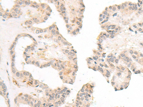 Immunohistochemistry of paraffin-embedded Human thyroid cancer tissue  using FBXW8 Polyclonal Antibody at dilution of 1:70(?200)