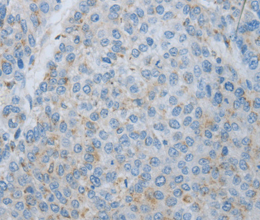 Immunohistochemistry of paraffin-embedded Human liver cancer using MMP25 Polyclonal Antibody at dilution of 1:80