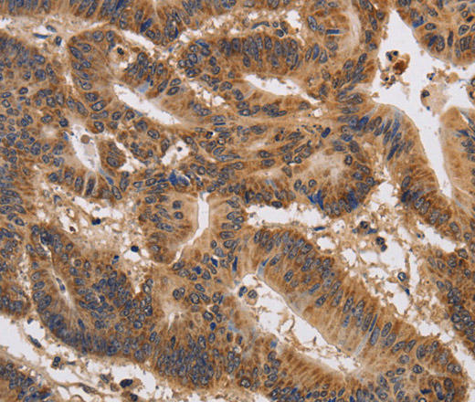 Immunohistochemistry of paraffin-embedded Human colon cancer using KCNK9 Polyclonal Antibody at dilution of 1:40