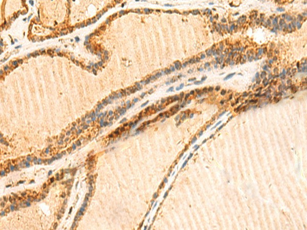 Immunohistochemistry of paraffin-embedded Human thyroid cancer tissue  using LYZL1 Polyclonal Antibody at dilution of 1:50(?200)