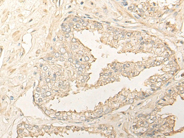 Immunohistochemistry of paraffin-embedded Human prost at e cancer tissue  using DIMT1 Polyclonal Antibody at dilution of 1:35(?200)