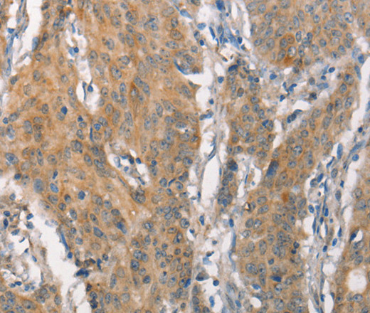 Immunohistochemistry of paraffin-embedded Human gastric cancer tissue using CEACAM6 Polyclonal Antibody at dilution 1:50