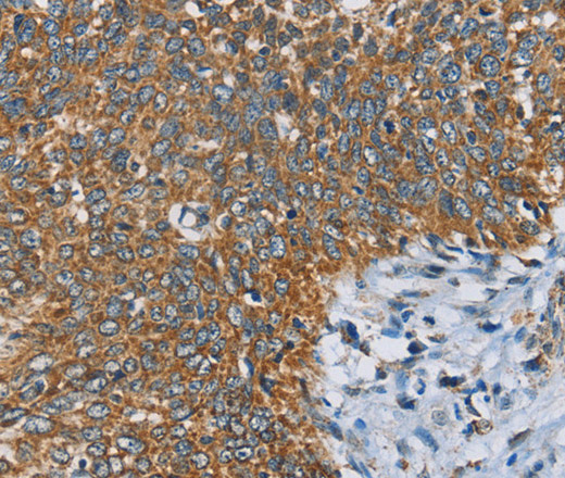 Immunohistochemistry of paraffin-embedded Human cervical cancer tissue using ANKHD1 Polyclonal Antibody at dilution 1:40