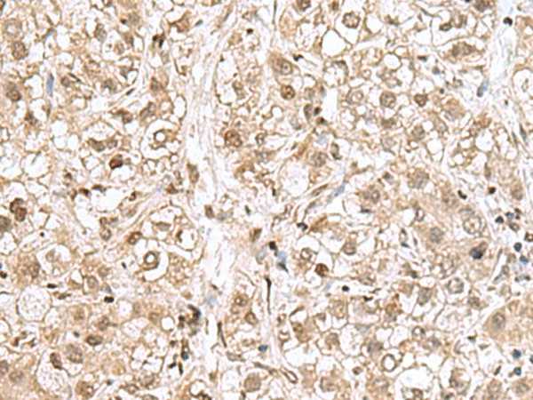 Immunohistochemistry of paraffin-embedded Human liver cancer tissue  using RPL35 Polyclonal Antibody at dilution of 1:70(?200)