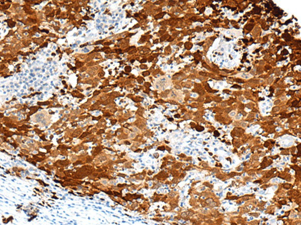 Immunohistochemistry of paraffin-embedded Human cervical cancer tissue  using FGD3 Polyclonal Antibody at dilution of 1:50(?200)