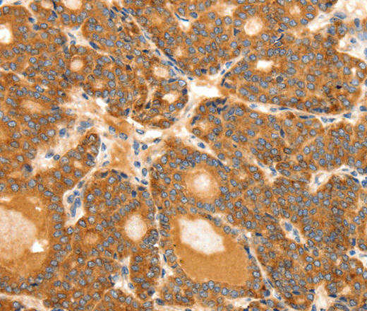 Immunohistochemistry of paraffin-embedded Human thyroid cancer tissue using SCT Polyclonal Antibody at dilution 1:40