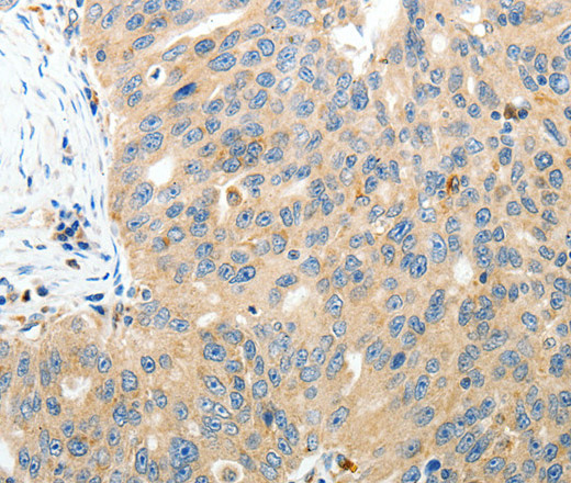 Immunohistochemistry of paraffin-embedded Human ovarian cancer tissue using RAMP3 Polyclonal Antibody at dilution 1:40