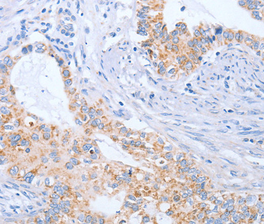 Immunohistochemistry of paraffin-embedded Human cervical cancer tissue using BST1 Polyclonal Antibody at dilution 1:50