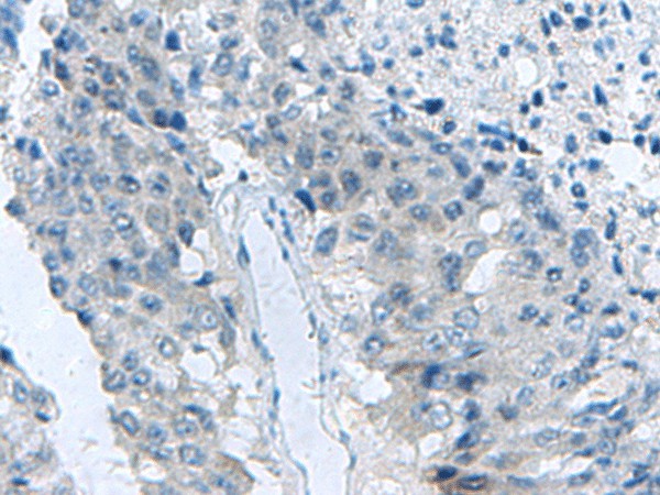 Immunohistochemistry of paraffin-embedded Human liver cancer tissue  using MED31 Polyclonal Antibody at dilution of 1:140(?200)