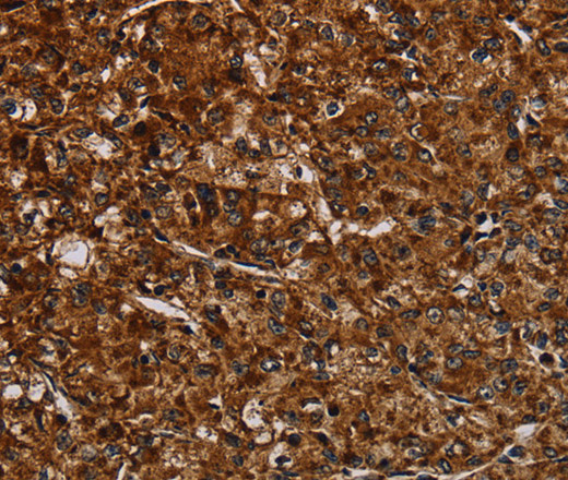 Immunohistochemistry of paraffin-embedded Human prostate cancer tissue using NDUFAB1 Polyclonal Antibody at dilution 1:50