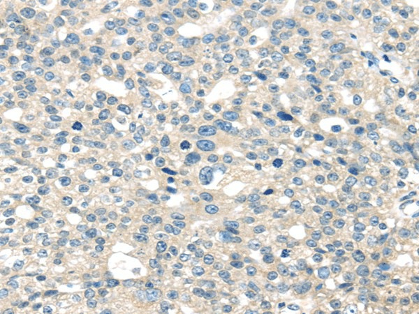 Immunohistochemistry of paraffin-embedded Human breast cancer tissue using TNFAIP8 Polyclonal Antibody at dilution 1:35