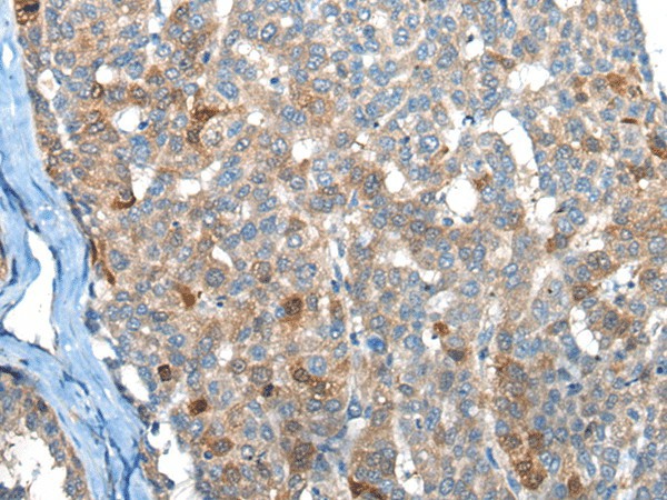 Immunohistochemistry of paraffin-embedded Human liver cancer tissue  using BHMT2 Polyclonal Antibody at dilution of 1:45(?200)