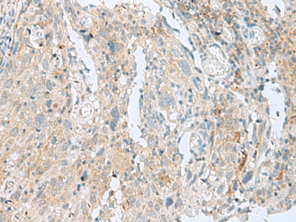 Immunohistochemistry of paraffin-embedded Human cervical cancer tissue  using SLC26A3 Polyclonal Antibody at dilution of 1:35(?200)